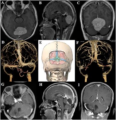 Technique notes on the management of superior sagittal or transverse sinus during the falcotentorial meningioma surgery: a case report